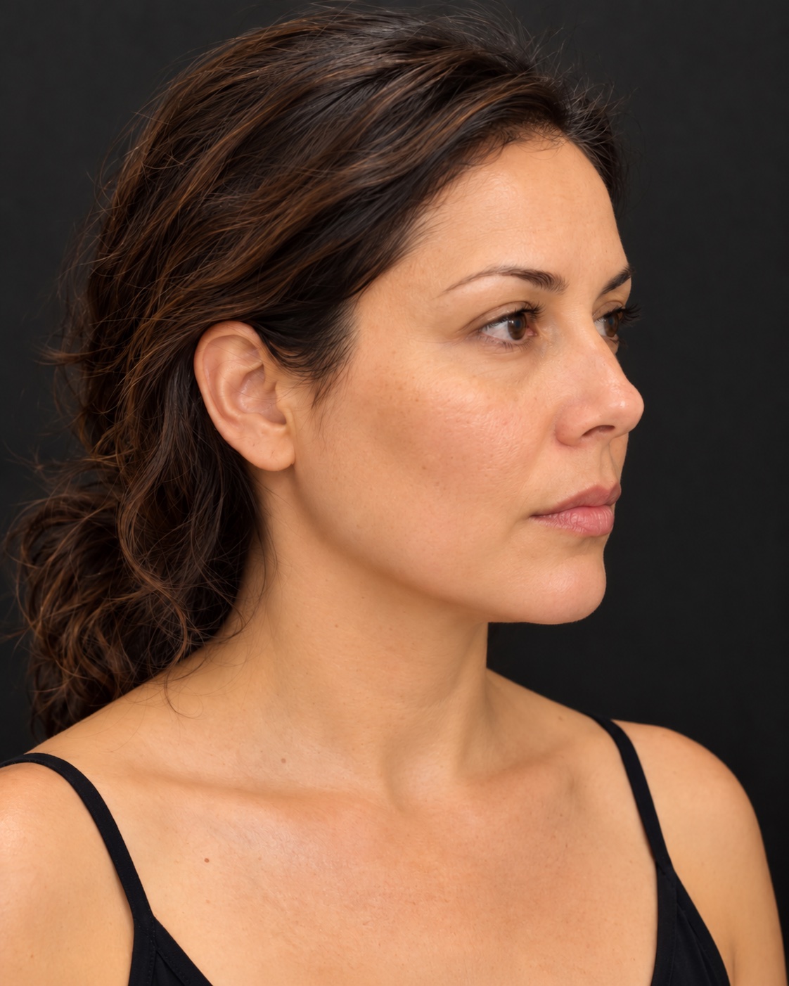 Client profile after treatment, with smoother, more even skin